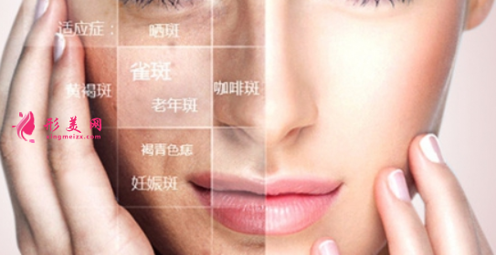 女人臉上色斑怎么快速祛除