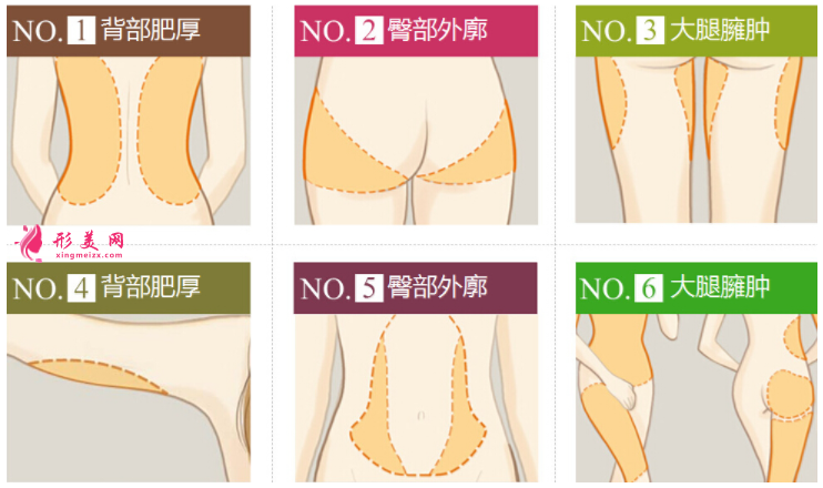 抽脂減肥哪里比較好