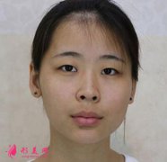 上海九院雙眼皮修復(fù)效果圖好嗎？手術(shù)60天前后對(duì)比圖一覽