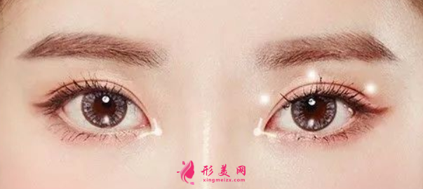 雙眼皮整形的效果怎么樣