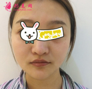 濟(jì)南海峽整形醫(yī)院面部吸脂后臉部輪廓好清晰，雙下巴不見了
