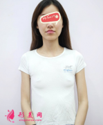 北京煤炭總醫(yī)院整形科假體隆胸后真人實(shí)拍案例 秒變C罩杯