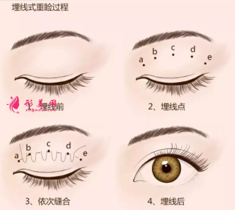 埋線雙眼皮術(shù)后要怎樣護(hù)理