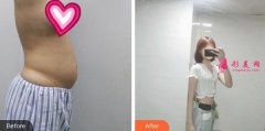 上海時光整形外科水動力吸脂瘦肚子案例