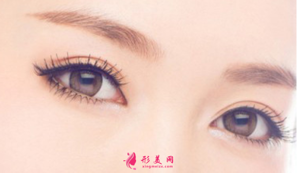 埋線雙眼皮手術(shù)多久能恢復(fù)