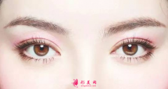 埋線雙眼皮手術多久能恢復？