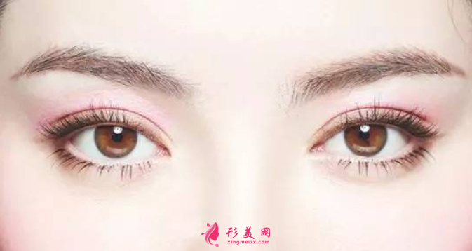 埋線雙眼皮手術(shù)多久能恢復(fù)