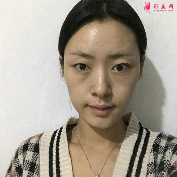 給大家安利下我在重慶藝星割的雙眼皮恢復(fù)過程