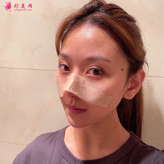分享下我在貴陽華美做的硅膠假體隆鼻自體軟骨墊鼻尖恢復(fù)效果