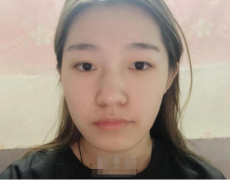 純脂醫(yī)療美容二次填充技術(shù)怎么樣親身面部脂肪填充案例分享
