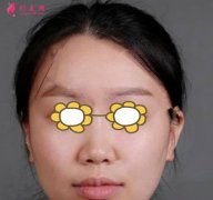 上海伊萊美醫(yī)療美容醫(yī)院怎么樣？隆鼻+面部吸脂后案例分享