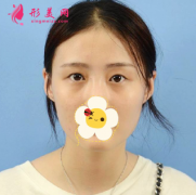 鄭州附二院整形科眼綜合真人案例，眼型線條很流暢 簡直美翻