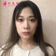 上海薇琳整形好不好嗎?嶄新價(jià)格表內(nèi)附肋軟骨隆鼻日記