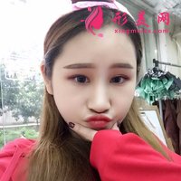 四川友誼醫(yī)院做的V-Line顏面輪廓整形90天恢復日記