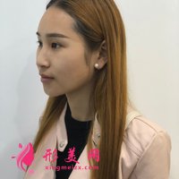 四川友誼醫(yī)院做的V-Line顏面輪廓整形90天恢復日記