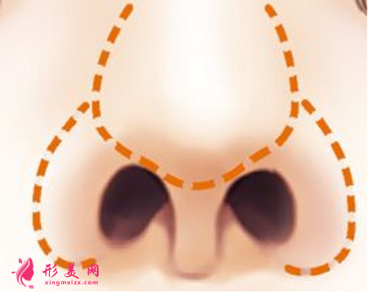 怎么縮小鼻翼比較好