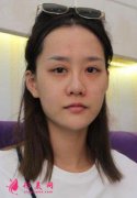 成都美容整形醫(yī)院的MINI藝術(shù)小全鼻你們看怎樣