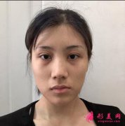 【鼻孔縮小手術(shù)對比圖案例】73天告別豬膽鼻!