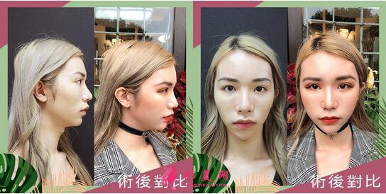 長沙美之峰謝燦雙眼皮案例在這，看不看隨你了~