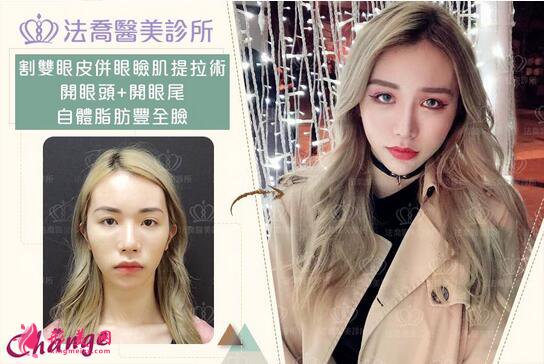 長沙美之峰謝燦雙眼皮案例在這，看不看隨你了~