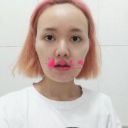 自體面部填充全臉前后對比圖：凍齡超好的方法