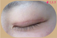 雙眼皮術(shù)后疤痕增生了還能消退嗎？
