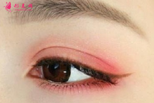 雙眼皮術(shù)后疤痕增生了還能消退嗎