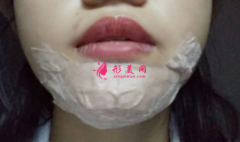 假體墊下巴前要做什么準備？