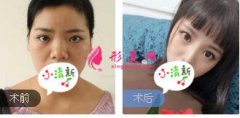 四川軍大整形鐘正強(qiáng)醫(yī)生鼻綜合整形案例 隆鼻前后對(duì)比