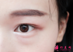 手術(shù)祛眼袋是怎么做的？