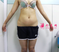 鄭州華領(lǐng)整形醫(yī)院全身多維立體吸脂案例 恢復(fù)苗條身材