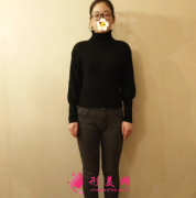 北京純脂整形醫(yī)院大腿吸脂術(shù)后穿啥都漂亮 美腿上線了