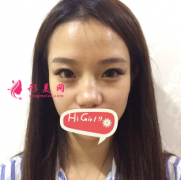 上海第九人民醫(yī)院假體隆鼻半年后效果真心不錯(cuò) 沒有留疤