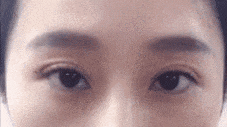 疤痕體質能割雙眼皮嗎