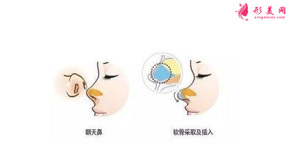 朝天鼻如何矯正