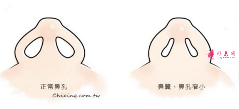 朝天鼻如何矯正