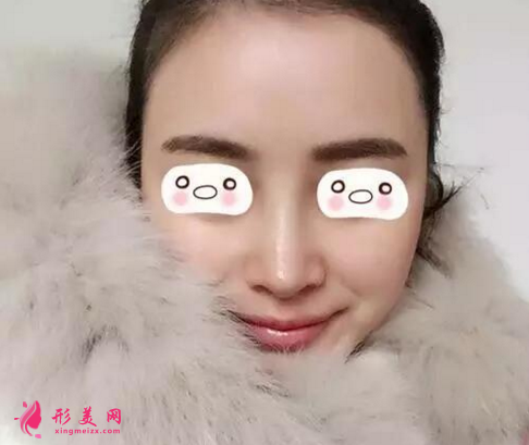 假體隆鼻好嗎？看看我的真實(shí)案例吧~