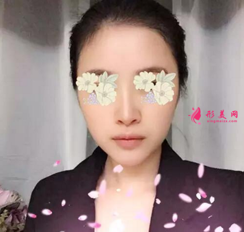 假體隆鼻好嗎？看看我的真實(shí)案例吧~