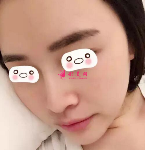 假體隆鼻好嗎？看看我的真實(shí)案例吧~