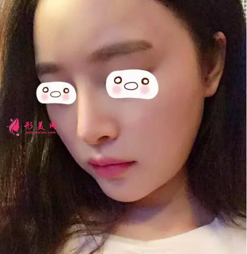 假體隆鼻好嗎？看看我的真實(shí)案例吧~