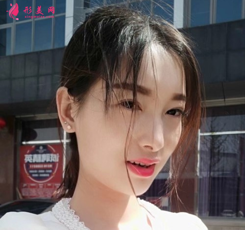 瘦臉針效果好不好？看我的術(shù)后恢復(fù)吧~