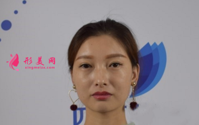 瘦臉針效果好不好？看我的術(shù)后恢復(fù)吧~