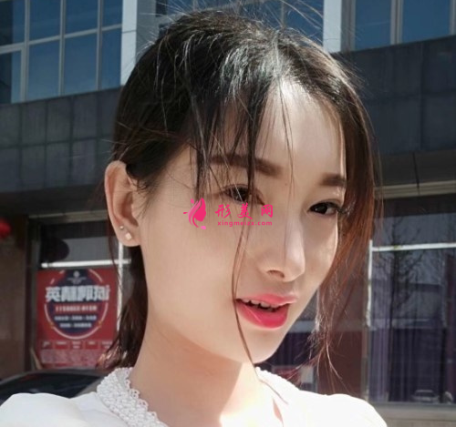 瘦臉針效果好不好？看我的術(shù)后恢復(fù)吧~