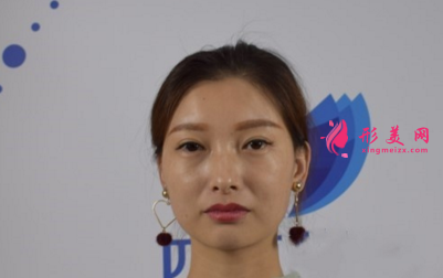 瘦臉針效果好不好？看我的術(shù)后恢復(fù)吧~