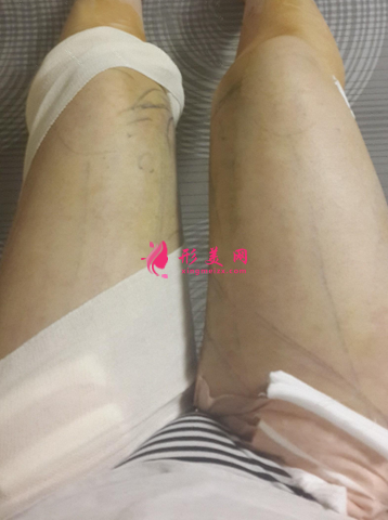腿部減肥吸脂對比圖，終于擺脫大象腿~