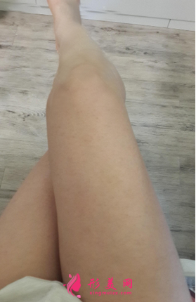 腿部減肥吸脂對比圖，終于擺脫大象腿~
