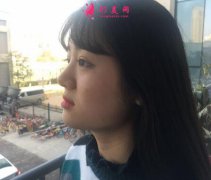瘦臉針有效嗎？看我術(shù)后恢復(fù)效果怎么樣！