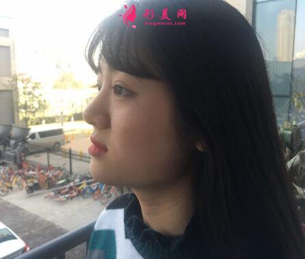 瘦臉針有效嗎？看我術(shù)后恢復(fù)效果怎么樣！