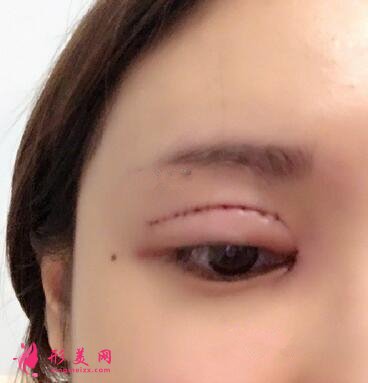 變美日記分享：埋線雙眼皮多久能恢復(fù)？