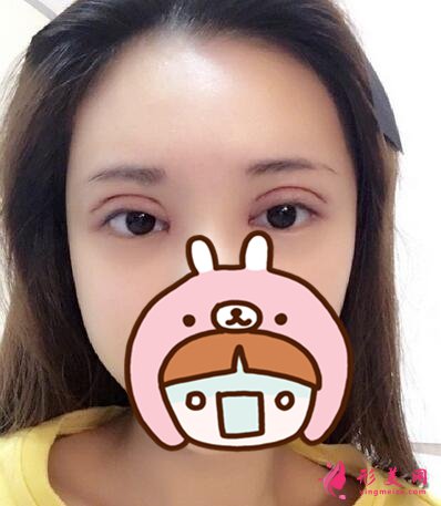 變美日記分享：埋線雙眼皮多久能恢復(fù)？